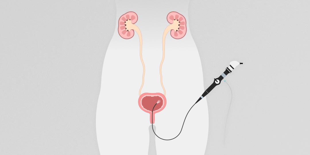 Tratamento endoscópico de refluxo vésico-ureteral