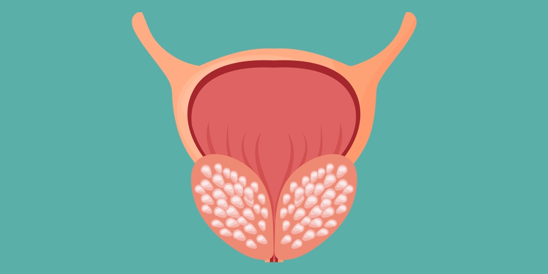 Tudo sobre a hiperplasia prostática benigna