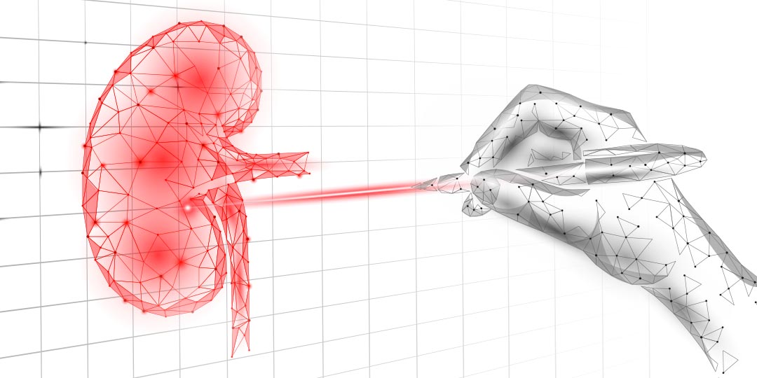 O uso do laser de alta potência no tratamento de cálculo renal