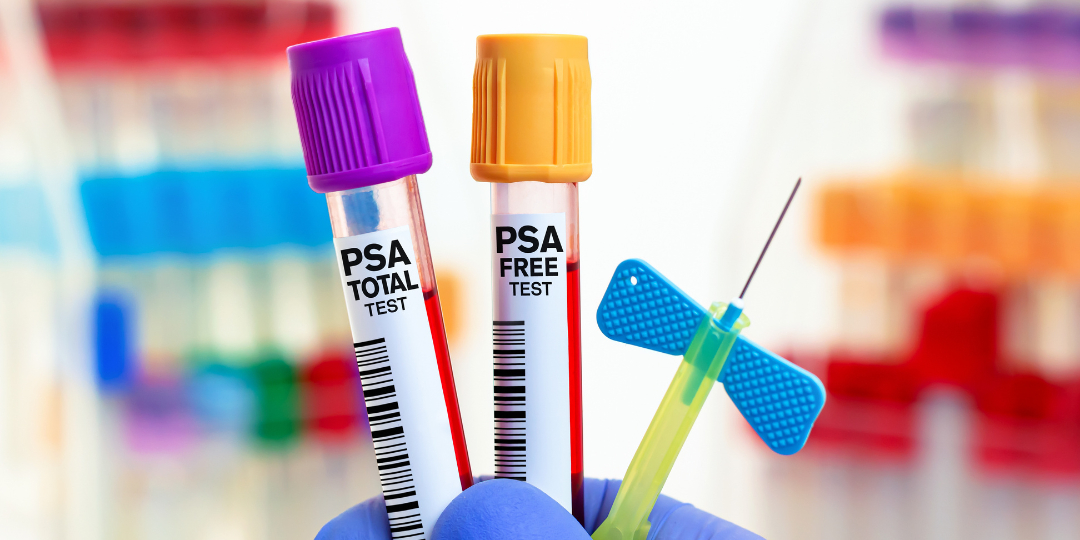 PSA alterado: o que pode indicar e quais os próximos passos